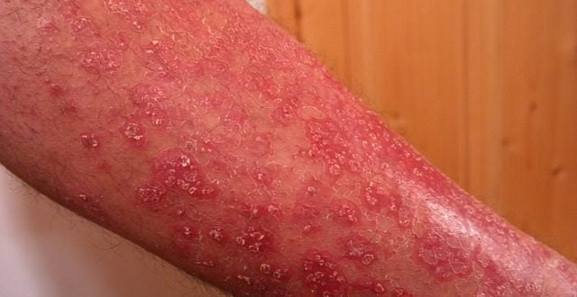 Psoriasis Gutata Gejala Penyebab Dan Pengobatan Hello Sehat