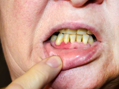 infeksi gusi periodontitis