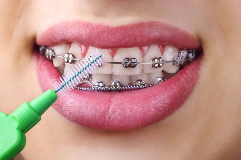 membersihkan kawat gigi