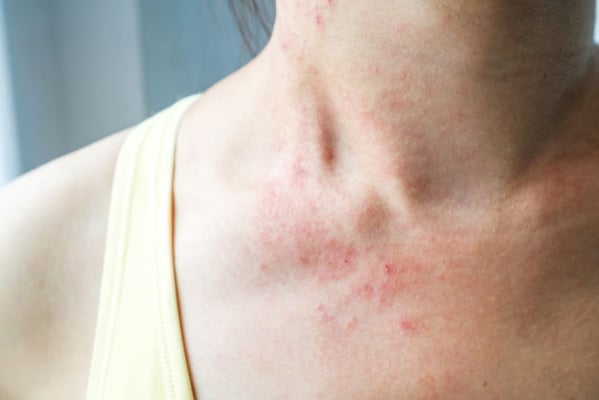 Penyebab gatal pada kulit yang tak kunjung sembuh