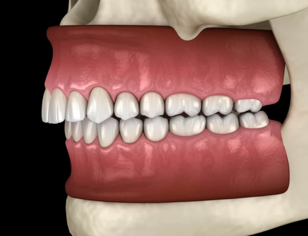 Penyebab Gigi Tonggos dan Pilihan Cara Memperbaikinya 