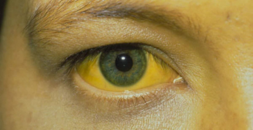 Mata kuning gejala hepatitis