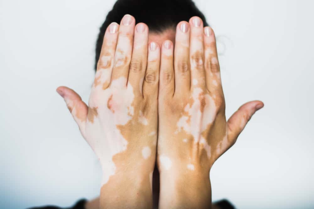 Obat Vitiligo Serta Penanganan Lainnya yang Ampuh