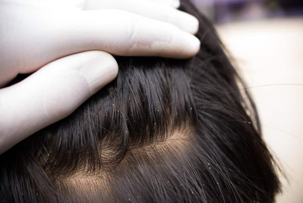 Obat Kutu Rambut yang Juga Dapat Menghilangkan Gatal di Kulit Kepala