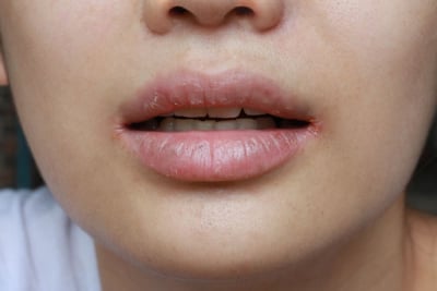 angular cheilitis luka di bibir