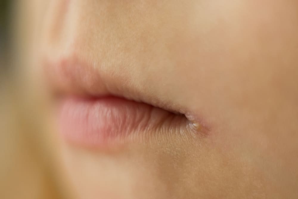 angular cheilitis adalah luka di bibir