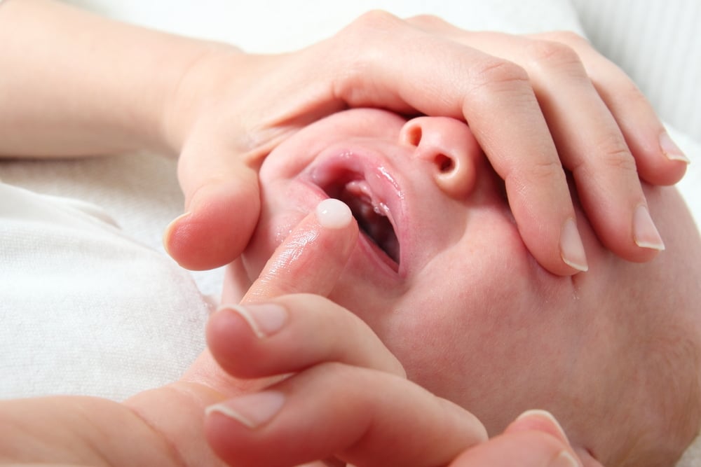 Mulut Bayi Berjamur, Bagaimana Cara Mengatasinya?