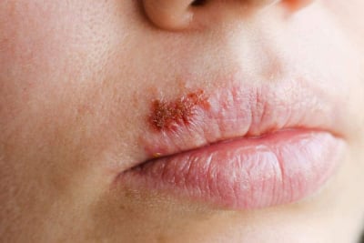 herpes mulut cold sore