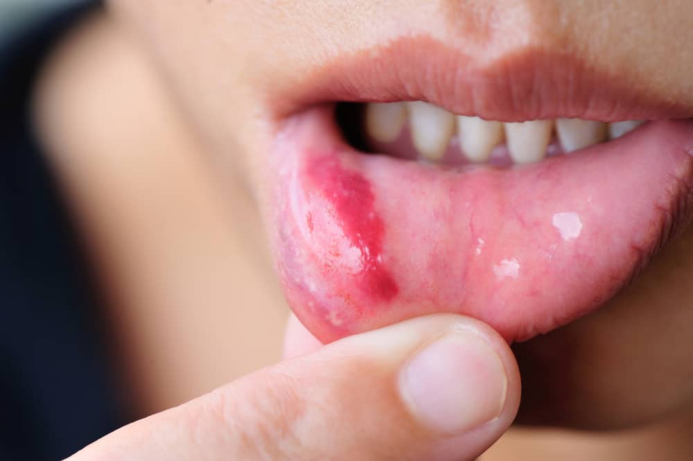 4 Jenis Luka di Mulut dan Penyebabnya yang Perlu Anda Waspadai