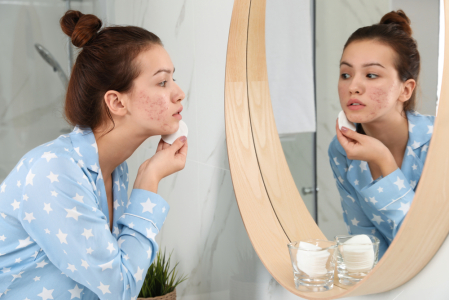 5 Jenis Skincare yang Ampuh untuk Merawat Kulit Remaja