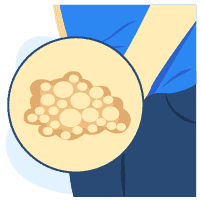 Herpes Genital dan Oral