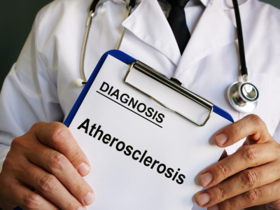 ateroklerosis