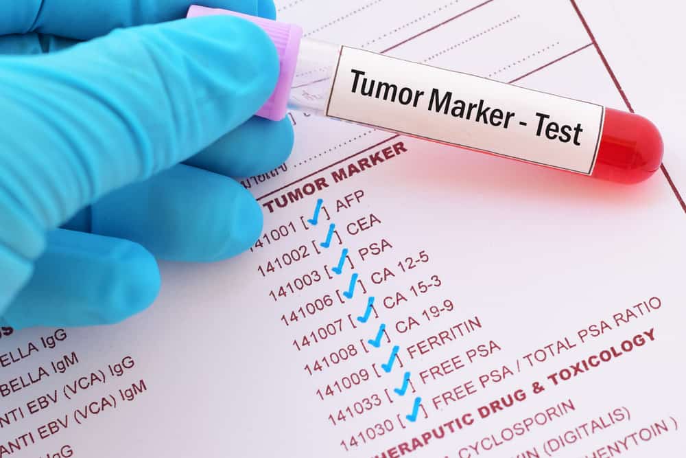 Ketahui Manfaat dan Jenis Tumor Marker untuk Pemeriksaan Kanker