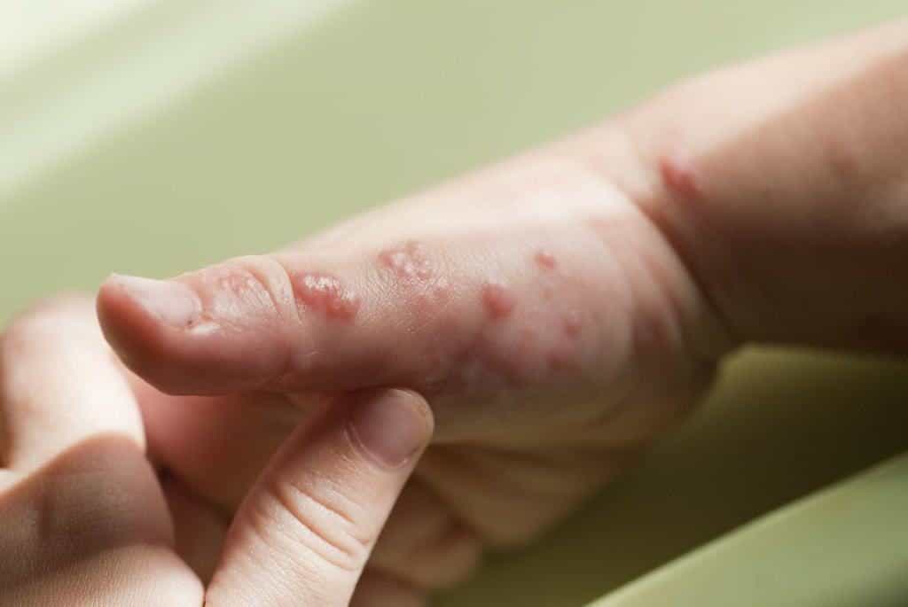 Semua Yang Perlu Anda Tahu Tentang Dermatitis Kontak Hello Sehat