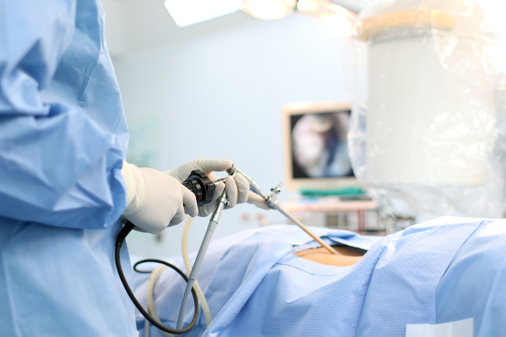 sleeve-gastrectomy-laparoskopi