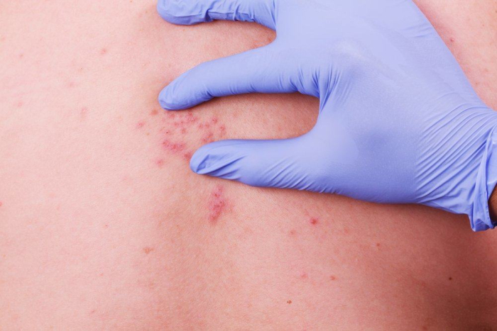 apa itu herpes zoster? cacar air atau cacar ular nyeri