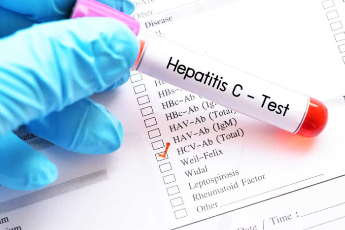 virus hepatitis c