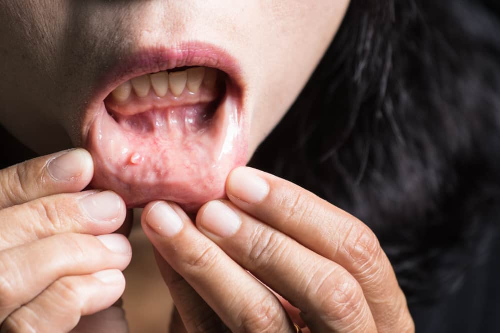 kanker mulut gusi gigi bibir