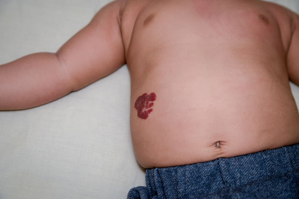 Hemangioma pada Bayi, Pertumbuhan Pembuluh Darah Abnormal