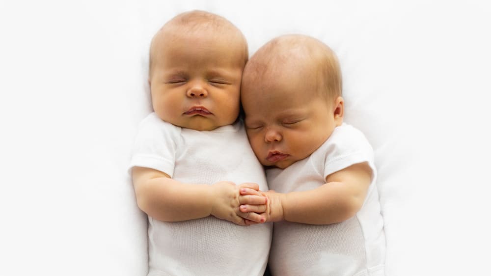 Kembar Siam, Ketika Bayi Lahir dengan Bagian Tubuh Saling Menempel