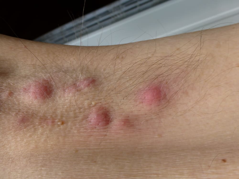 Hidradenitis Suppurativa