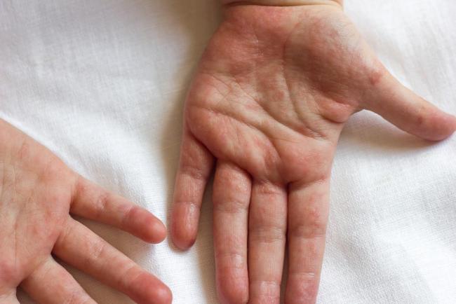 Herpetic Whitlow, Infeksi Virus Herpes di Jari Tangan