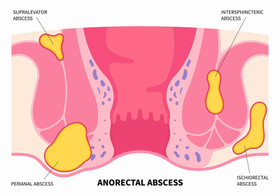 ilustrasi abses anus