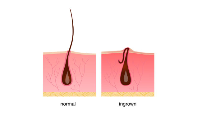 Inner Rambut Ingrown Hair (Rambut Tumbuh ke Dalam): Gejala, Penyebab, Pengobatan