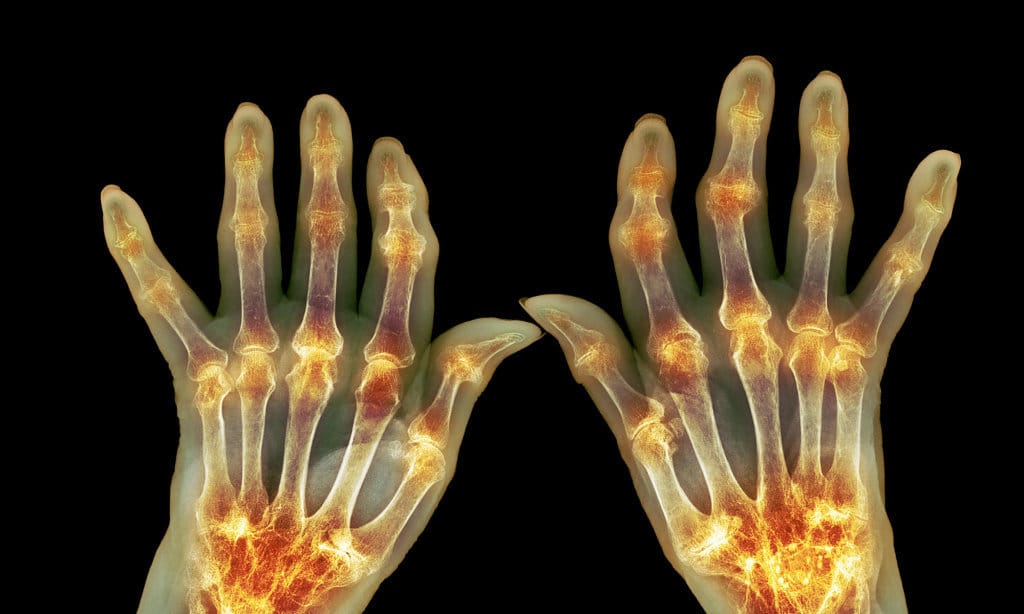 Terjadi arthritis merupakan pada yang peradangan RHEUMATOID ARTHRITIS.