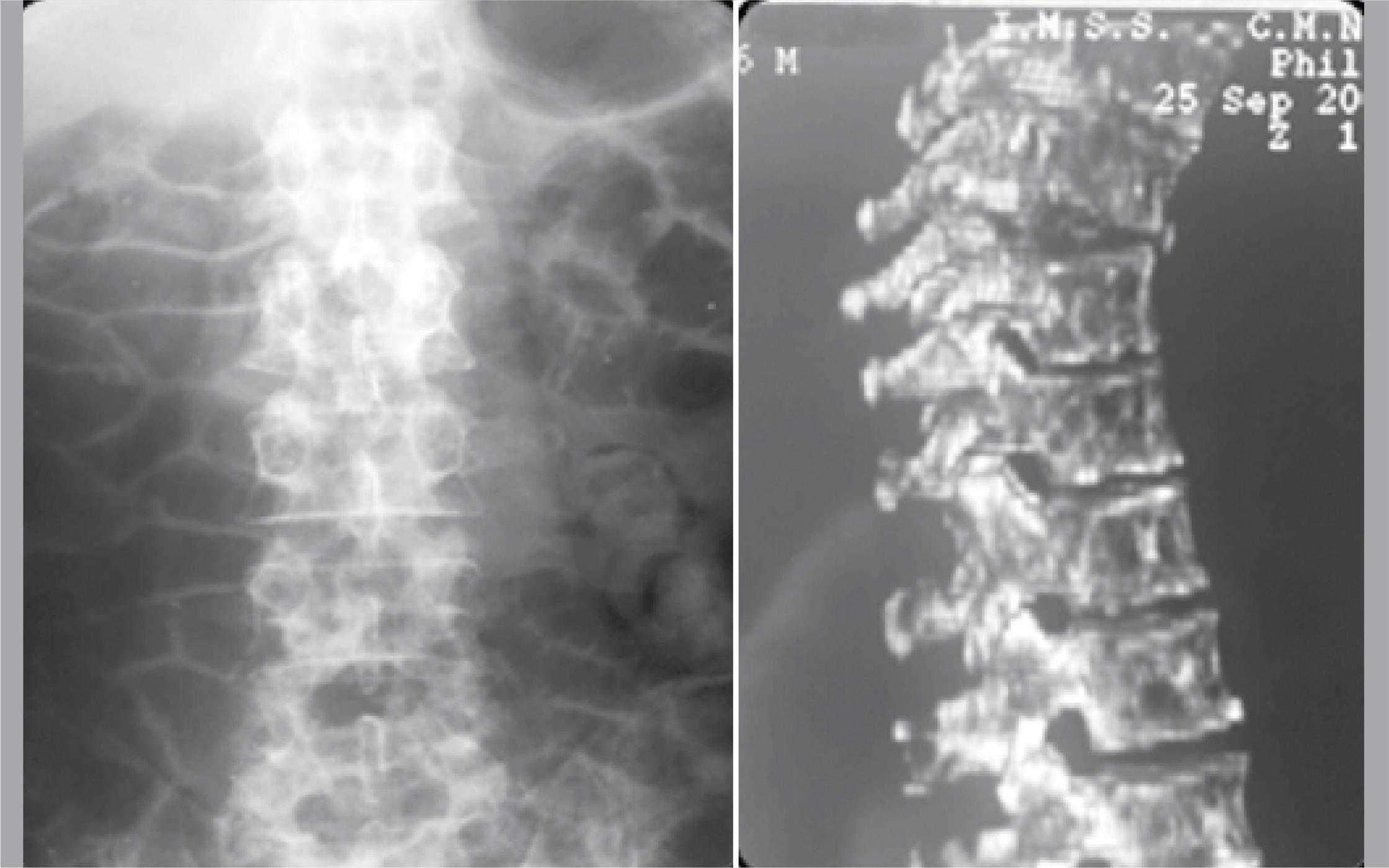 Multiple Myeloma