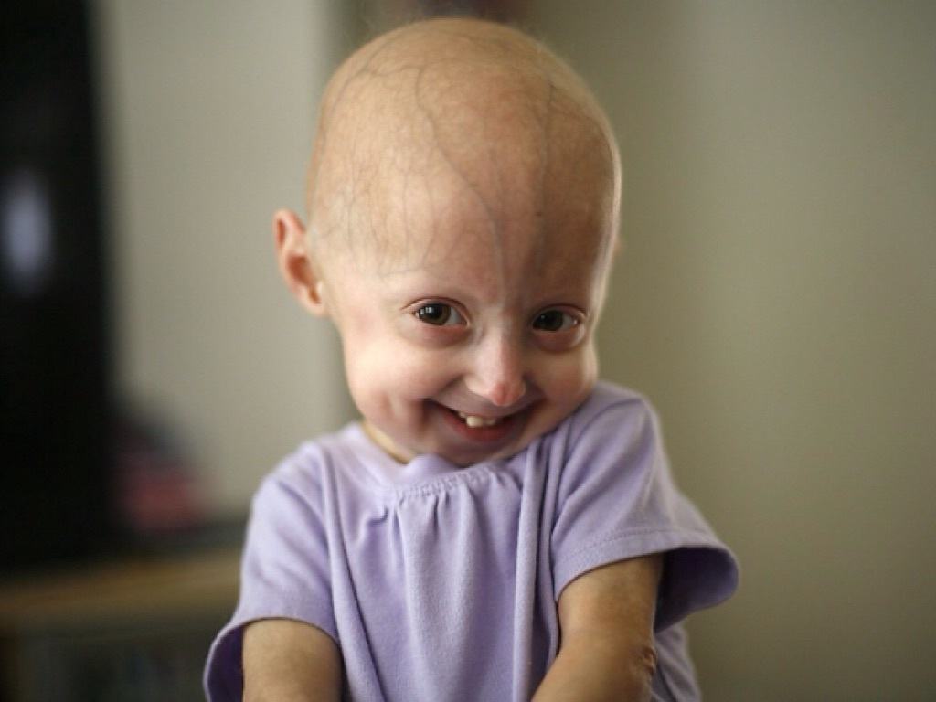 Progeria, Kondisi Saat Penampilan Fisik Bayi Tampak Menua