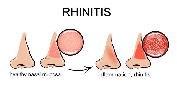 Rhinitis Vasomotor