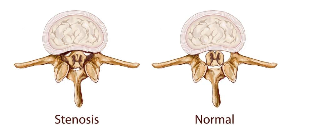 Penyempitan Tulang Belakang (Spinal Stenosis)
