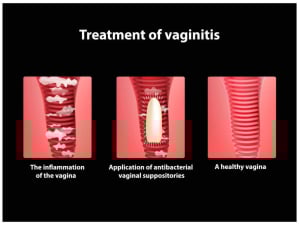 vaginitis atau radang vagina