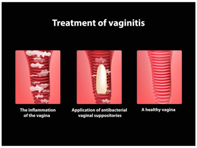 pengertian-vaginitis