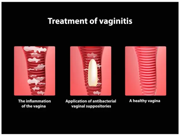 Vaginitis: Gejala, Penyebab, Pengobatan, dan Pencegahan