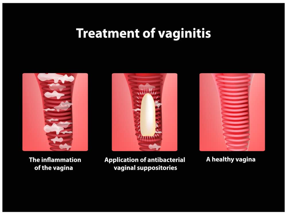 vaginitis atau radang vagina