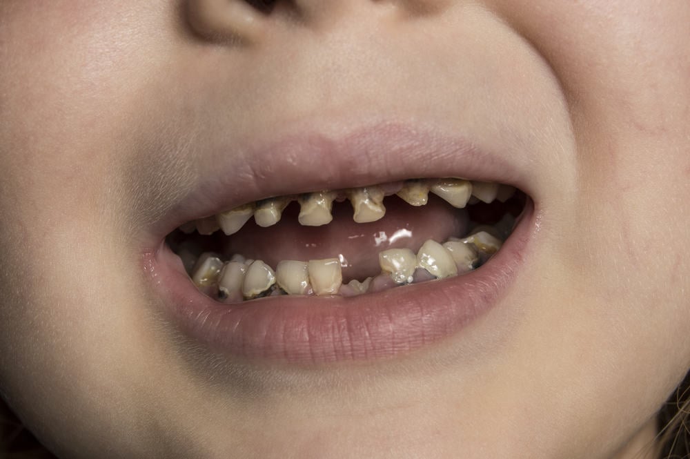 gigi anak rusak karena gigi gigis