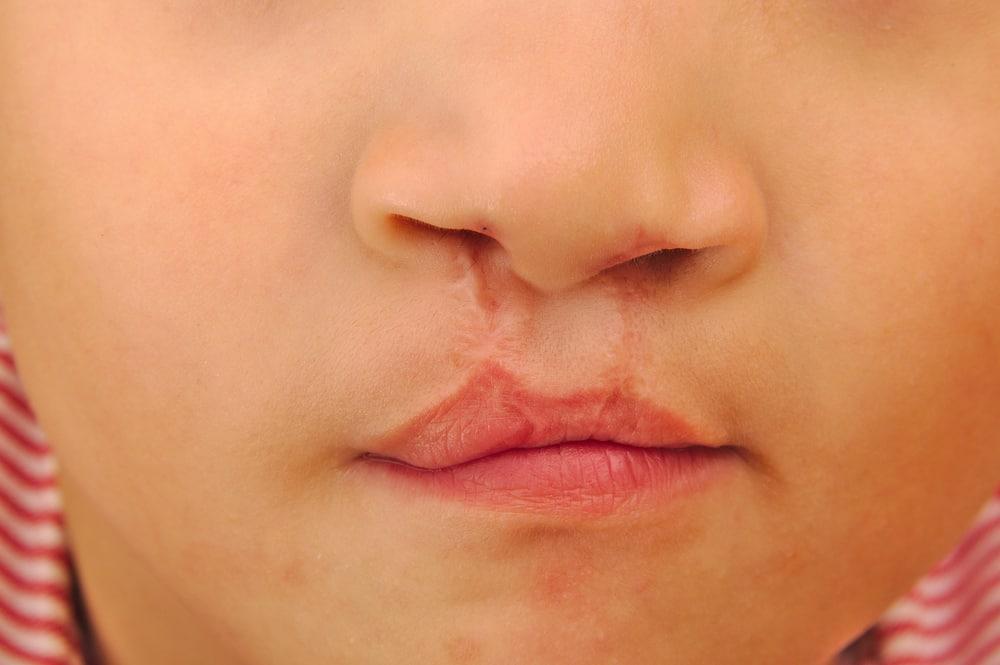 Bibir Sumbing