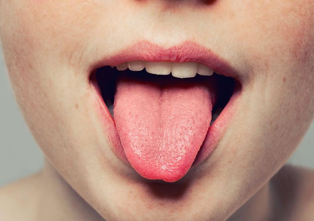 Black Hairy Tongue