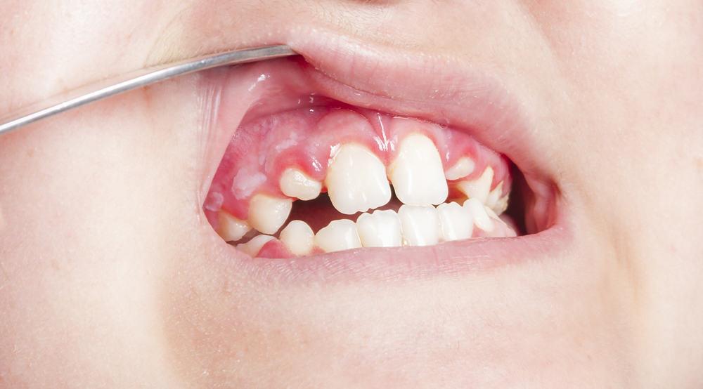 Gingivitis