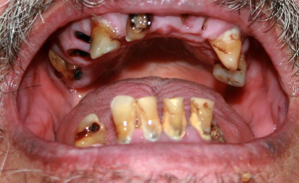 Meth Mouth