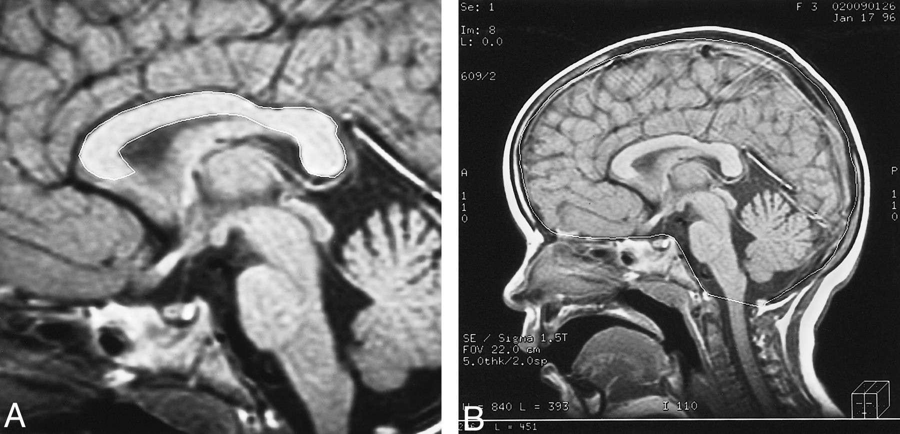 Neurofibromatosis Tipe 2