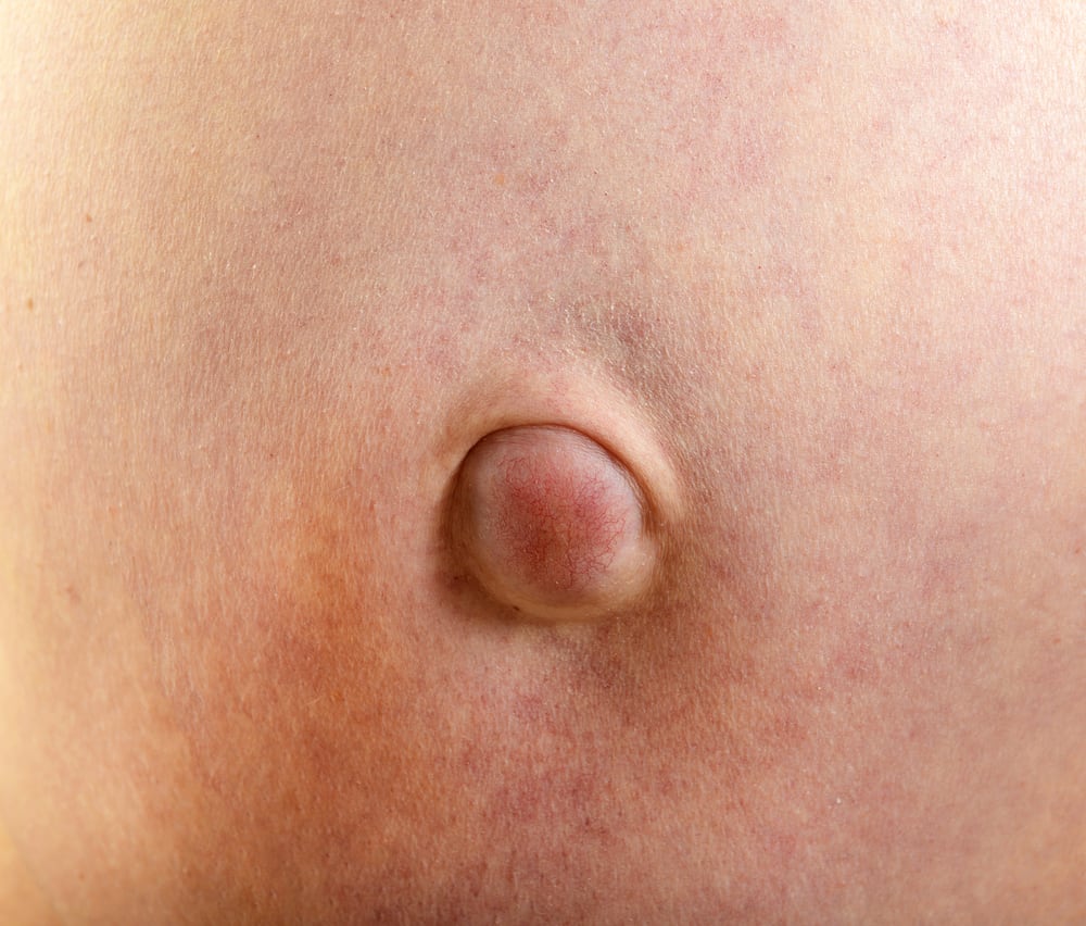 Hernia Umbilikalis