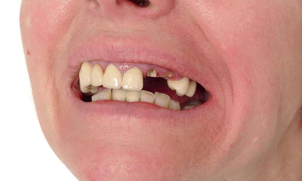 Trench Mouth