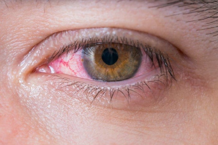 alergi konjungtivitis mata merah