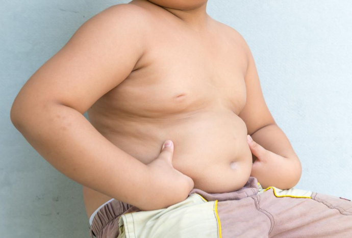 obesitas pada anak