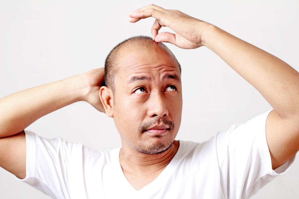 Perawatan Rambut Botak, Apa yang Perlu Diperhatikan?