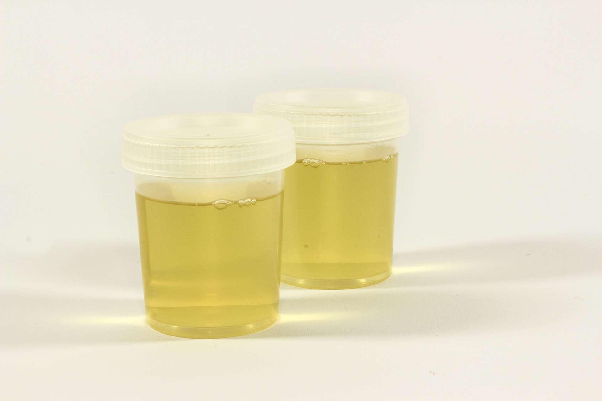 Mengenal Proteinuria, Protein di Dalam Urine Anda