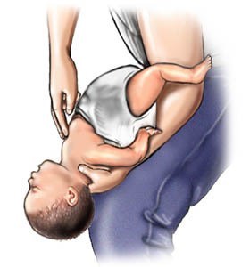 Langkah menolong bayi yang tersedak (4-5) sumber: www.webmd.com